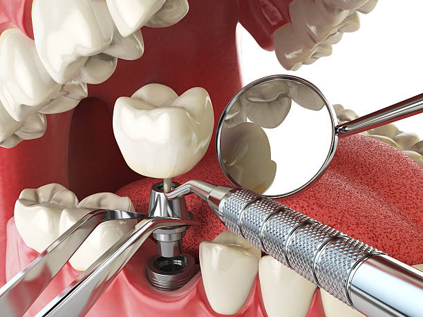 Best Emergency Tooth Extraction in Atwood, TN